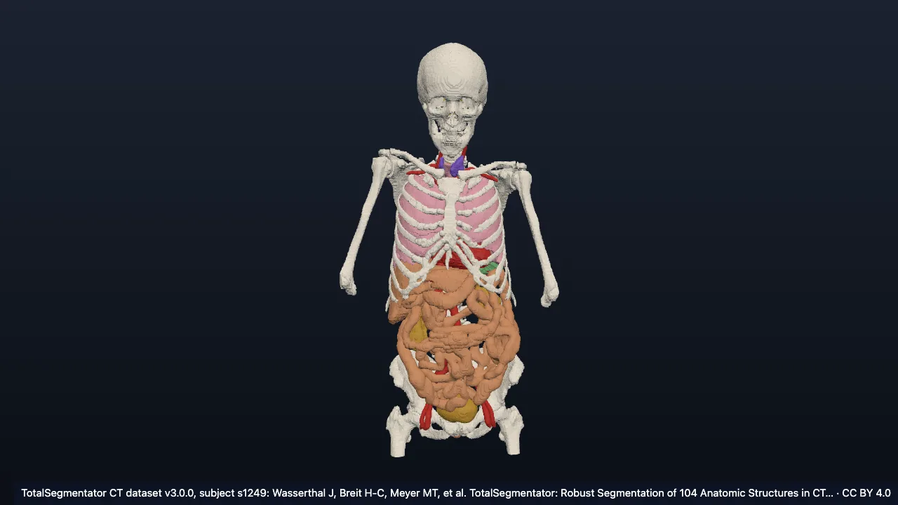 Real CT case s1249: female, 93