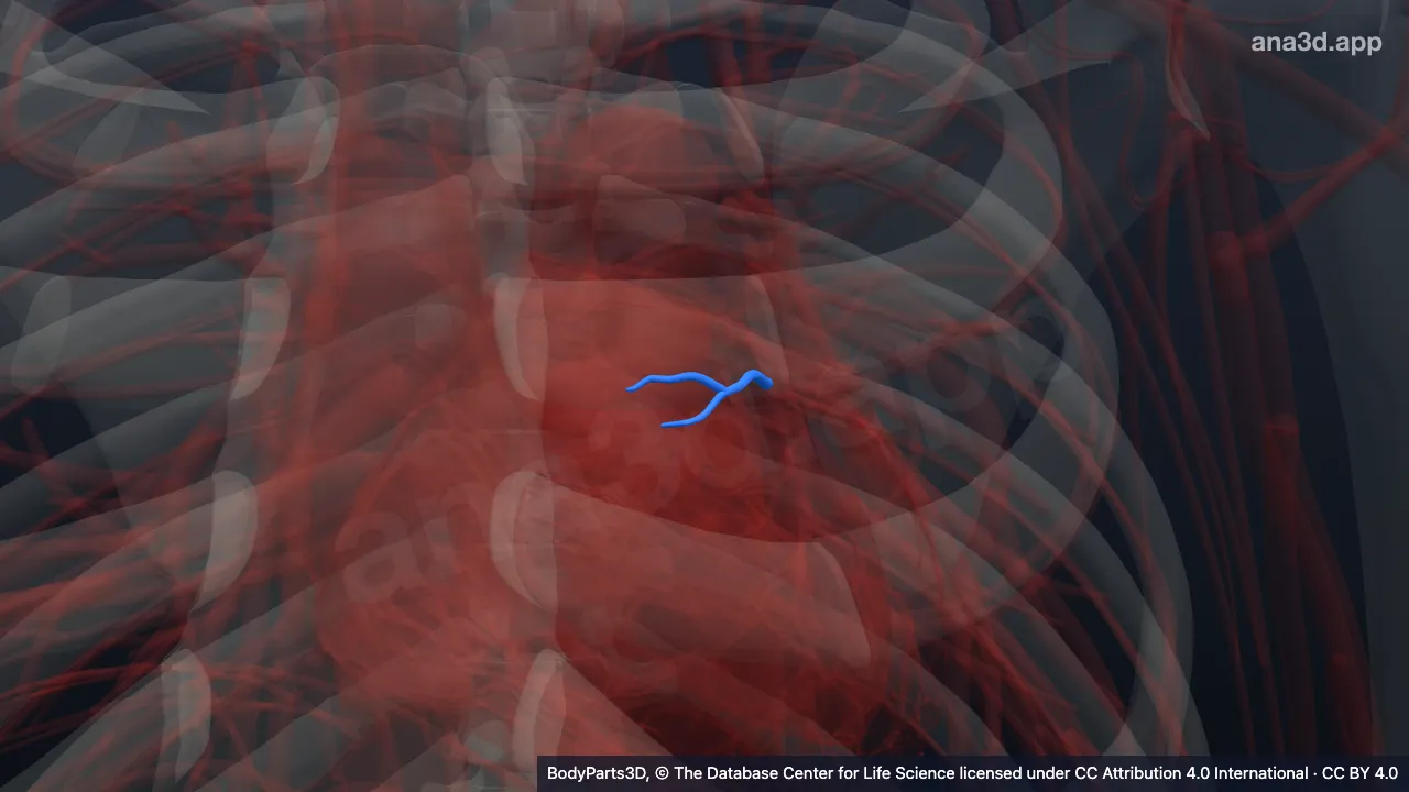 3D model: conus branch of anterior interventricular branch of left coronary artery