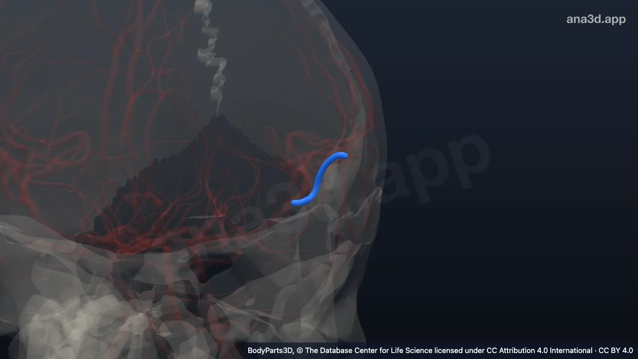 3D model: trunk of inferior terminal branch of left middle cerebral artery