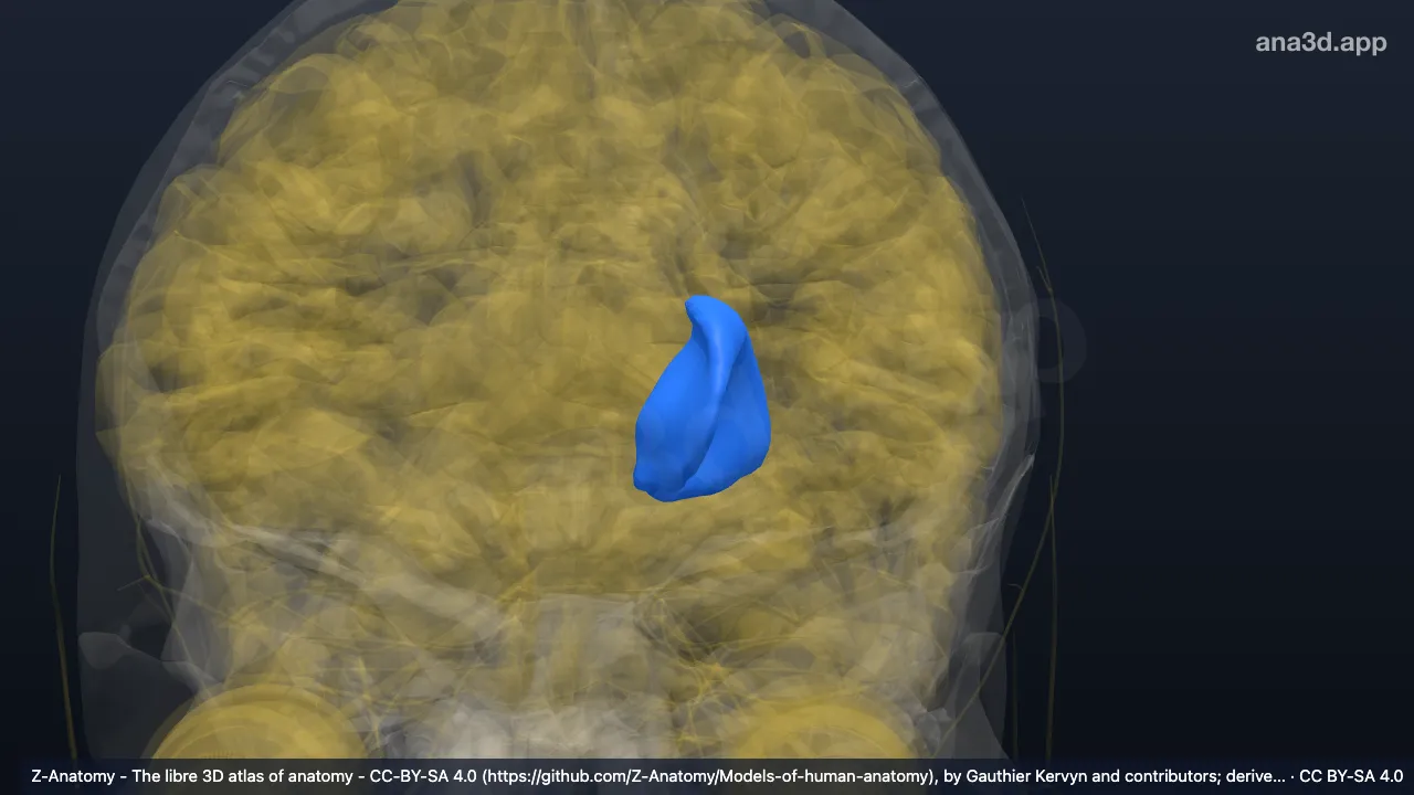 Modelo 3D: Núcleo lentiforme esquerdo