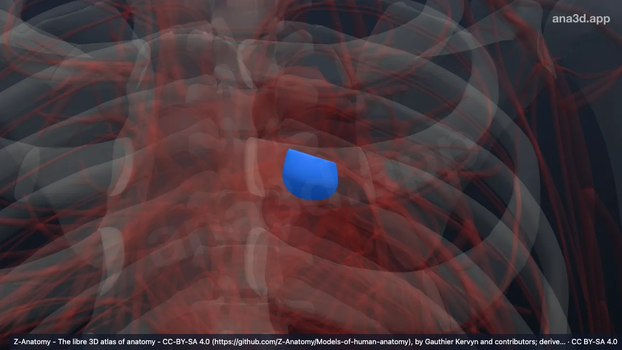 Model 3D: Daun katup semilunaris anterior katup pulmonal