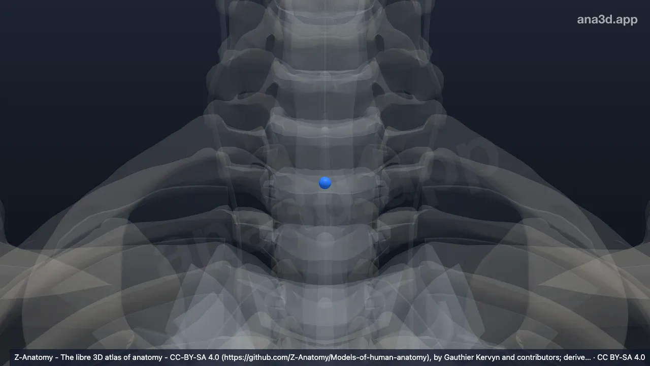 Modelo 3D: Núcleo pulposo T1-T2