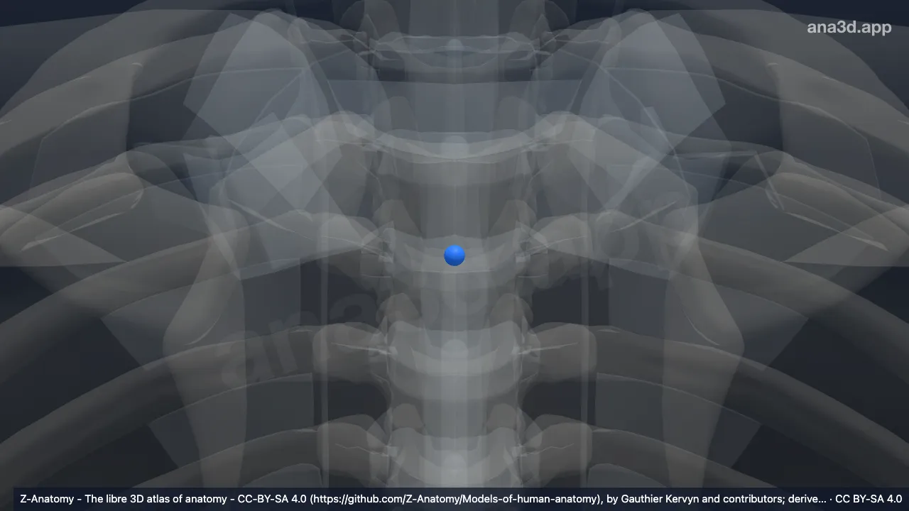 Modelo 3D: Núcleo pulposo T3-T4