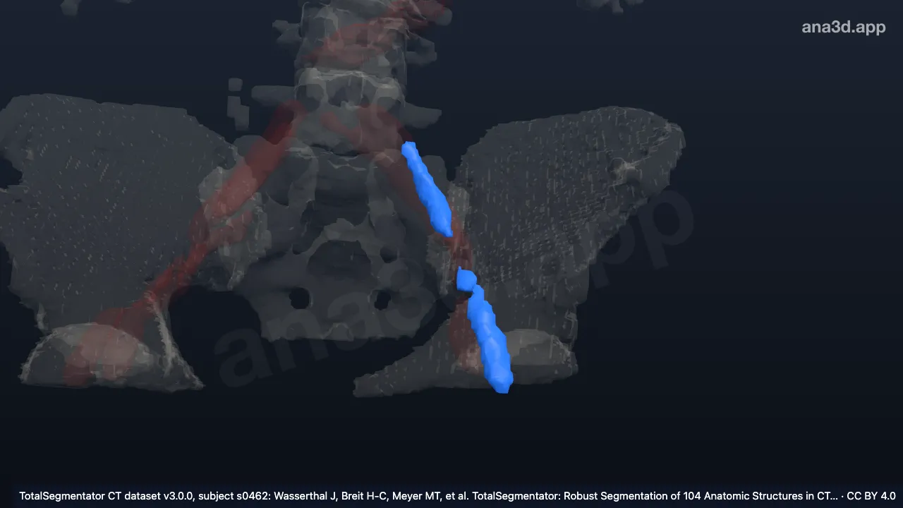 Modelo 3D: Artéria ilíaca esquerda
