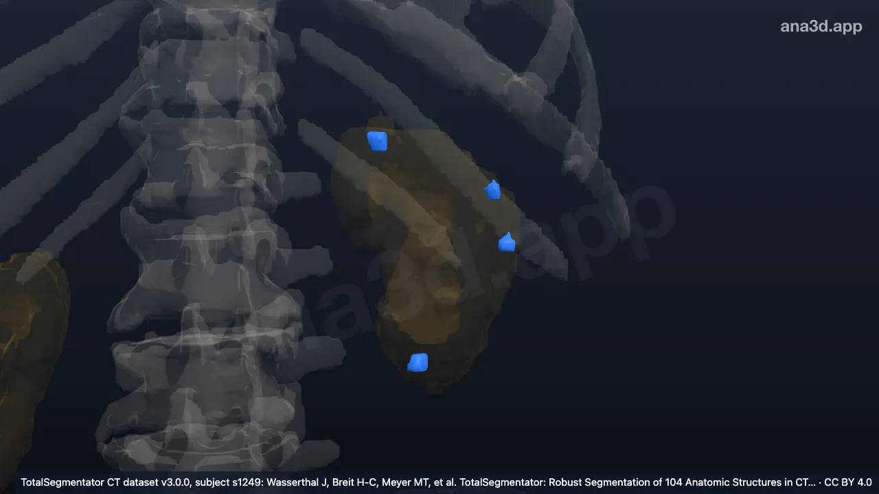 Modelo 3D: Cisto do rim esquerdo